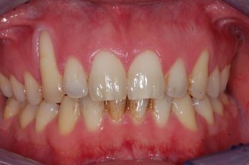 Zahnfleischrückgang Was wenn das Zahnfleisch zurückgeht