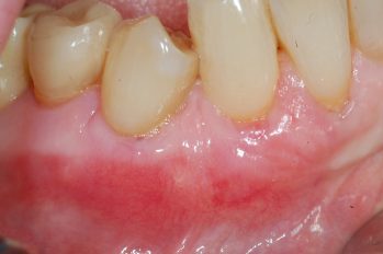 Wiederherstellung von verlorenem Zahnfleisch durch Transplansplantation von Gaumengewebe. Neubildung einer stabilen Zahnfleischdichtung. Abdeckung und Schutz von der zuvor freiliegenden Wurzeloberfläche. Perfekte Farbe und Optik.