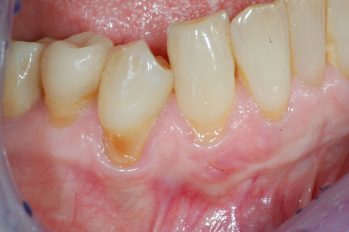 Deutlicher Zahnfleischrückgang im Unterkiefer - Eckzahnbereich. Durch Fehlstellung des Zahnes und Abrieb durch Zähneputzen bedingter Substanzverlust der Wurzeloberfläche.Empfindlichkeit und Beweglichkeit des Zahnfleisches und damit fehlende Abdichtung.