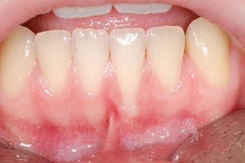 Zahnfleischrückgang am unteren Schneidezahn bedingt durch ungleichmäßige Stellung der Zahnwurzeln und sehr dünnen Kieferknochen. Beginnende Schmerzhaftigkeit beim Zähenputzen bedingt durch Beweglichkeit im Bereich der äußeren Zahnfleischdichtung. Zusätzliche Behinderung durch Einstrahlendes Lippenbändchen.