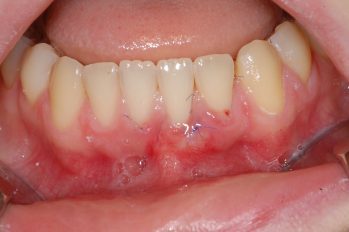 Zunächst Wiederherstellung und Aufbau der Zahnfleischdichtung durch Transplantation von Gaumengewebe.
Später kann vielleicht noch eine Anpassung des Lippenbändchens sinnvoll sein.