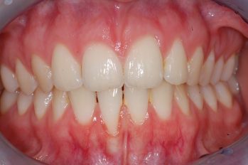 Im Bereich der Unterkieferfrontzähne liegt eine generell sehr dünnes Zahnfleisch und ein dünner Kieferknochen vor.
Ein Zahnfleischrückgang ist bereits am rechten unteren Schneidezahn eingetreten.
Ein genereller Aufbau von Zahnfleisch im Bereich der unteren Schneidezähne ist sinnvoll, um langfristig weiteren Zahnfleischrückgang zu vermeiden und damit den Erhalt der unteren Schneidezähne zu sichern.