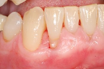 Zahnfleischrückgang bedingt durch deutliche Fehlstellung der unteren Frontzähne. Der seitliche rechte Frontzahn steht im Vergleich zum mittleren rechten Schneidezahn deutliche weiter nach außen. Dadurch bedingt hat dieser Zahn auf der Außenfläche einen viel dünneren Kieferknochen und dünneres Zahnfleisch.
Ein Aufbau von Zahnfleisch und eine Veränderung der Zahnputztechnik kann hier zunächst helfen. Zusätzlich kann durch eine kieferorthopädische Korrektur der Frontzähne der Druck beim Zähneputzen auf das äußere Zahnfleisch reduziert werden.