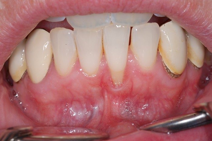 Zahnfleischrückgang am unteren linken Schneidezahn von 3 - 4 mm. Verlust von abdichtendem Zahnfleisch. Hierdurch bedingte Entzündung. Ursächlich durch einen sehr dünnen Kieferknochen und durch eine weit nach außen stehende Wurzel des betroffenen Schneidezahnes.
Wiederaufbau von abdichtendem Zahnfleisch durch Transplantation von Gaumengewebe, sowie nachfolgende Korrektur des Lippenbändchen.
Eine Korrektur der Wurzelneigung durch eine kieferorthopädische Maßnahme würde den langfristigen Erfolg deutlich Verbessern.