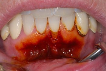 Durch Färbelösung kann die Verteilung  von abdichtendem Zahnfleisch zu beweglicher Mundschleimhaut dargestellt werden. In diesem Fall ist klar zu erkennen, dass der linke seitliche Schneidezahn äußerlich von beweglicher Mundschleimhaut umgeben ist.
Bei einer chirurgischen Korrektur sollte darauf geachtet werden, dass der Zahn dauerhaft von abdichtendem Zahnfleisch geschützt wird.