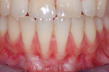 Anatomisch bedingte sehr dünne Knochen- und Zahnfleischverhältnisse im Bereich der unteren Frontzähne.
Eine Verdickung des sehr dünnen Zahnfleisches wird zunächst eine Abdeckung der feien Wurzeloberflächen erreichen und damit einem weiteren Rückgang stoppen.
Zukünftig sollte eine schonende Zahnputztechnik und fortlaufende Kontrollen stattfinden.