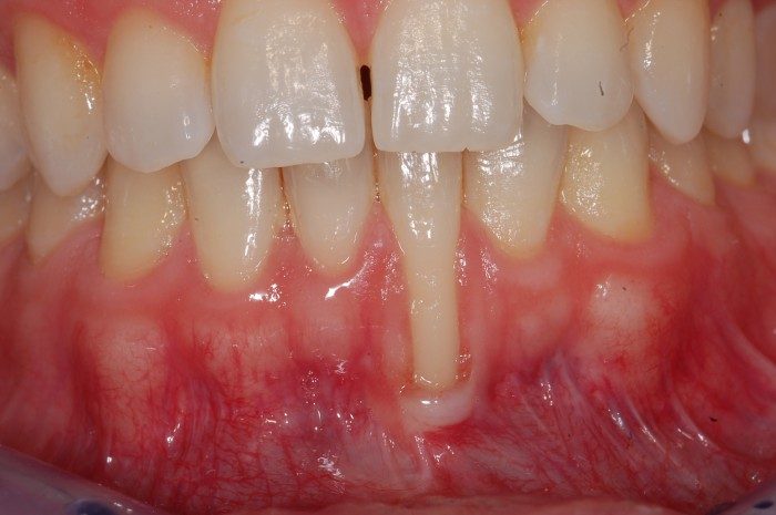 Extrem tiefe und ausgeprägte singuläre Rezession / Zahnfleischrückgang am unteren linken Frontzahn. Fehlende  Zahnfleischabdichtung durch vollständigen Verlust von abdichtendem Zahnfleisch auf der Außenfläche.
Ursächlich verstärkt durch eine Fehlstellung der Wurzel des betroffenen Zahnes.
Therapeutisch wäre eine Umstellung der Zahnwurzel für einen langfristigen Erfolg eines Wiederaufbaus des Zahnfleisches sehr sinnvoll.
