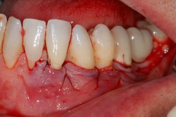 Hier wurde eine Kombination von chirurgischer Zahnfleischverlegung und Transplantation von Gaumengewebe verwendet.