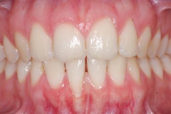 Sehr dünnes Zahnfleisch und extrem dünner Kieferknochen im Bereich der Frontzähne des Unterkiefers.
Bereits eingetretener Zahnfleischrückgang von 2 bis 3 mm am rechten unteren Schneidezahn. Empfindlichkeit des Zahnes aufgrund der freiliegenden Wurzeloberfläche. Schmerzhaftigkeit beim Zähnebürsten im Bereich des Zahnfleischrandes.